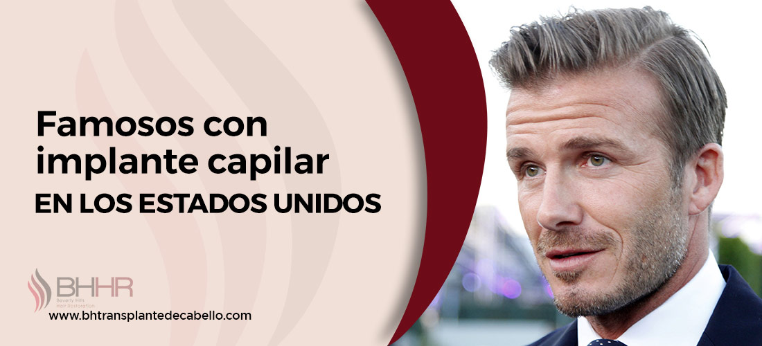 Famosos Con Implante Capilar