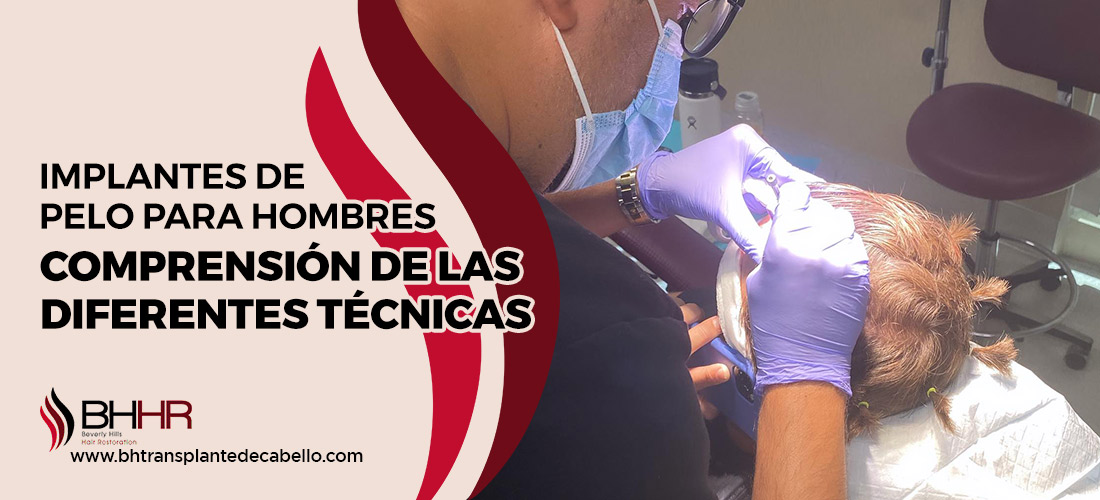 Implantes De Pelo Para Hombres 