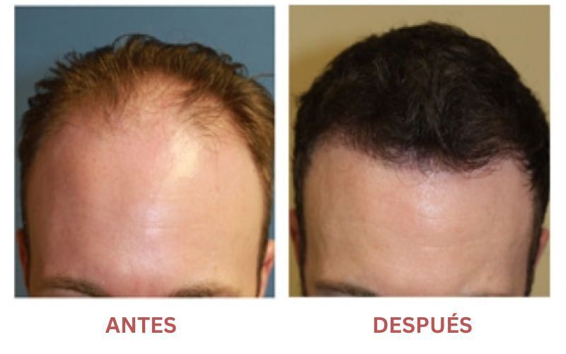 injerto capilar antes y despues