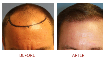 follicular-unit-extraction-fue