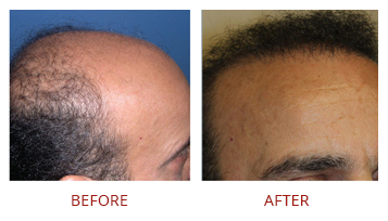 hair-transplant-strip-fut