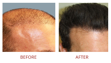 hair-transplant-strip-fut