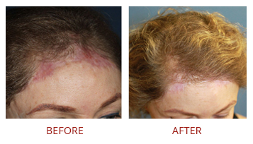 follicular-unit-extraction-fue