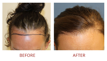 hair-transplant-solutions-3