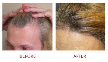 hair-transplant-solutions-4