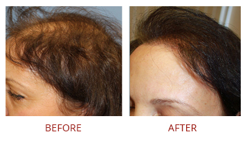 hair-transplant-strip-fut