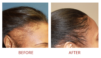 hair-transplant-solutions-6