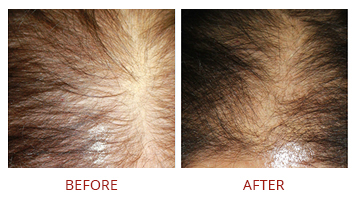 platelet-rich-plasma-prp-hair-restoration