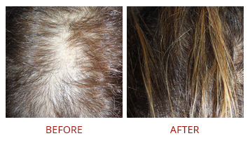 platelet-rich-plasma-prp-hair-restoration