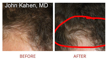 platelet-rich-plasma-prp-hair-restoration