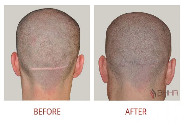 scalp-micropigmentation