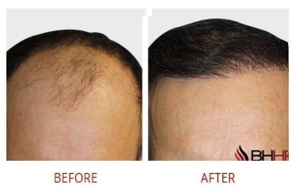 hair-transplant-solutions-1