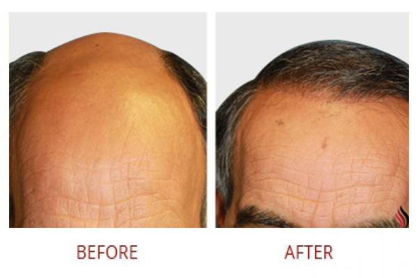 hair-transplant-solutions-2